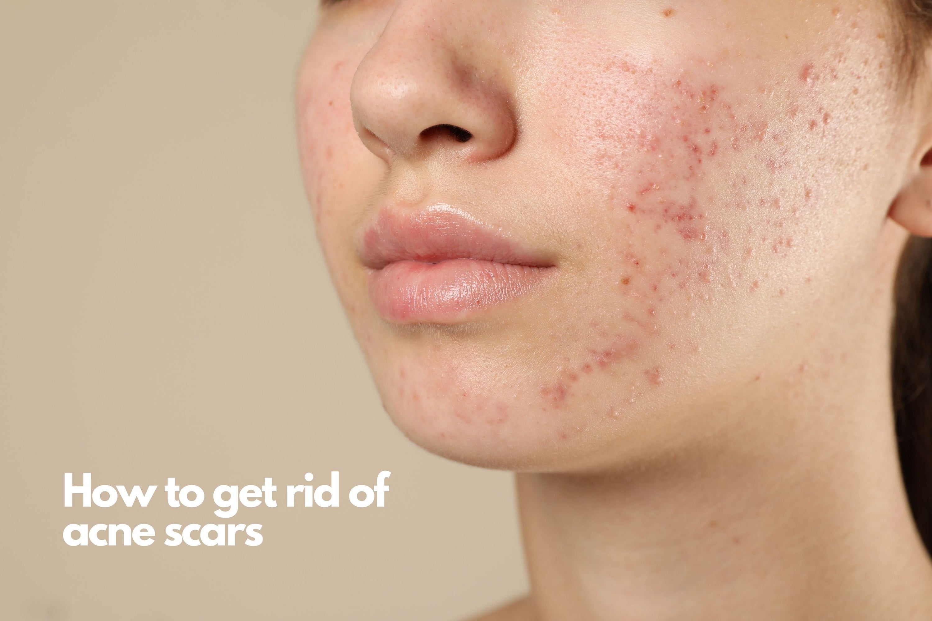 What causes acne and how to cure acne scars?