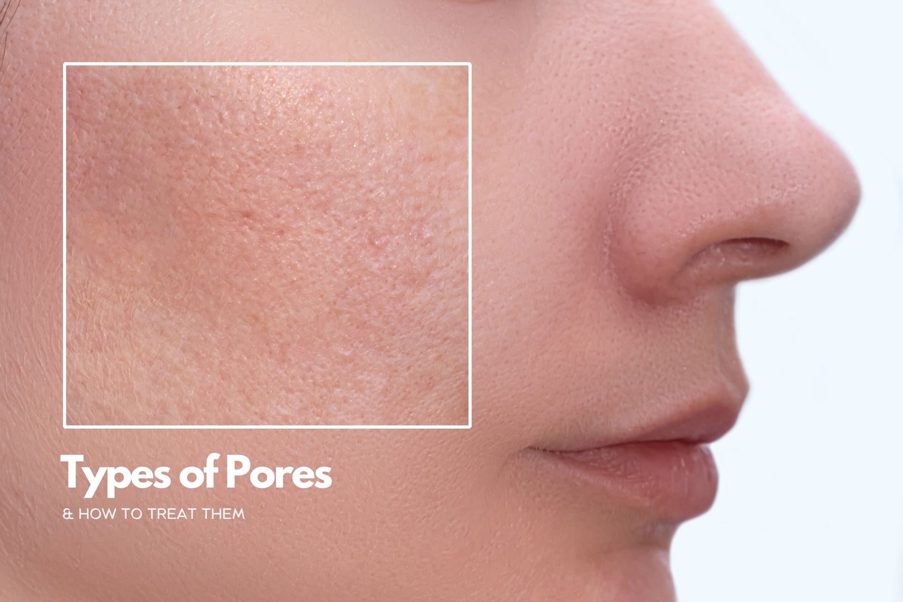 Types of Pores & How to treat them